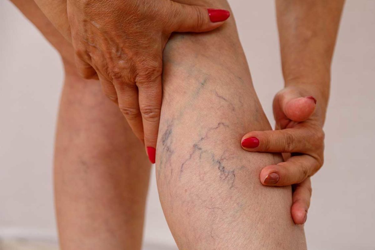 Varices